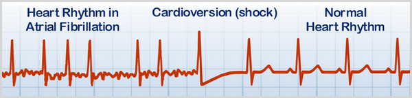 ECG showing heart rhythm in Atrial Fibrillation, cardioversion (shock), and normal heart rhythm